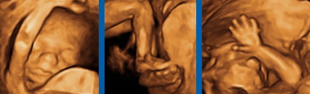 Ultraschall 3D